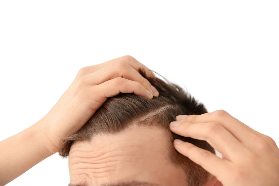 Minoxidil For Hair Loss in Men & Women